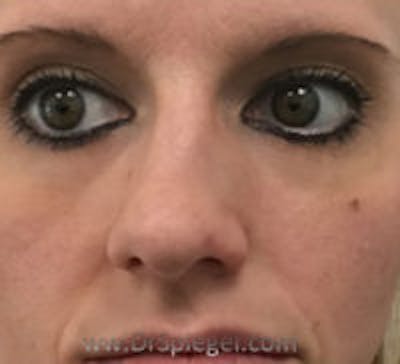 Rhinoplasty Before & After Gallery - Patient 367086 - Image 3