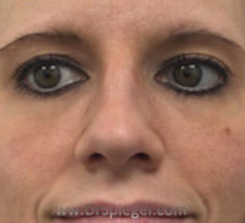 Rhinoplasty Before & After Gallery - Patient 367086 - Image 4