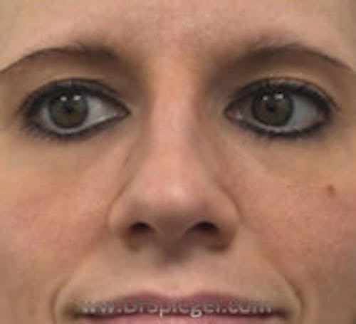 Rhinoplasty Before & After Gallery - Patient 367086 - Image 4