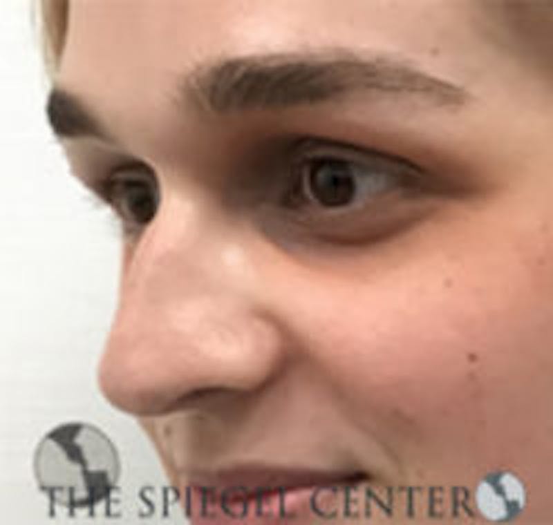 Rhinoplasty Before & After Gallery - Patient 103875 - Image 1