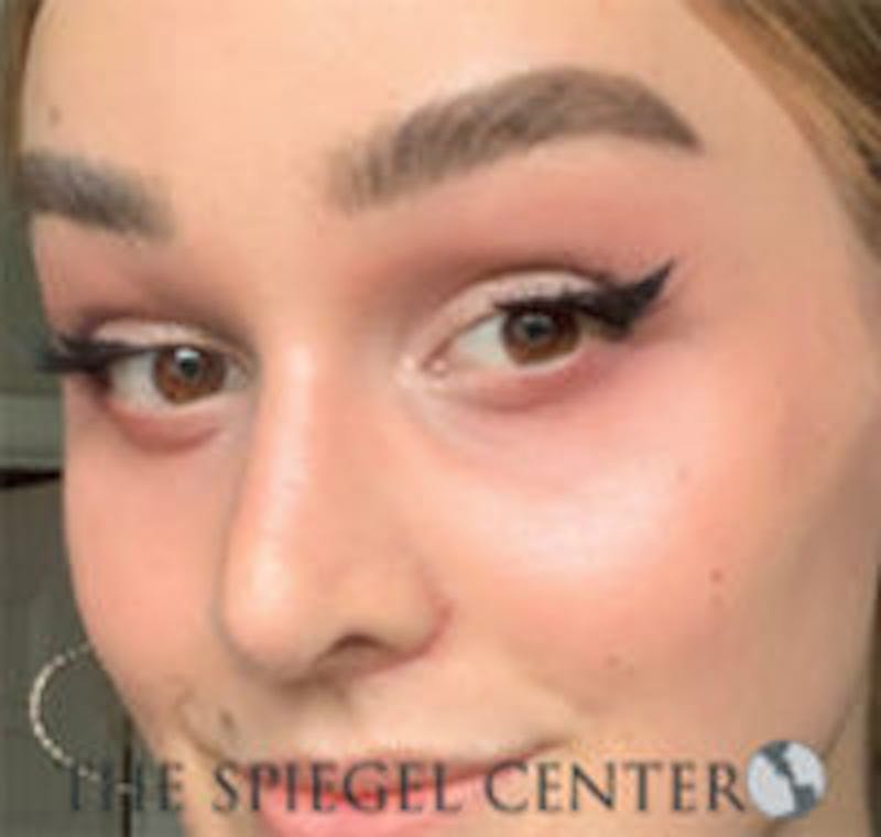 Rhinoplasty Before & After Gallery - Patient 103875 - Image 2