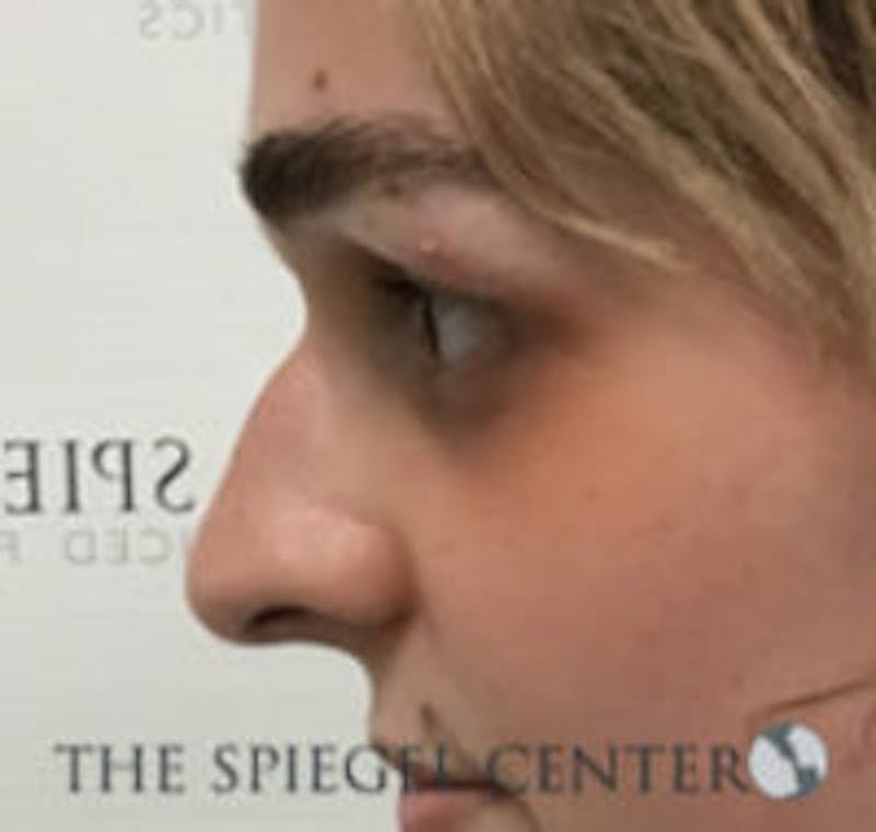 Rhinoplasty Before & After Gallery - Patient 103875 - Image 3