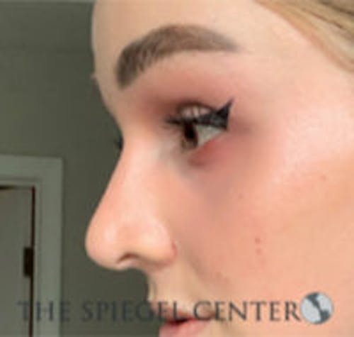 Rhinoplasty Before & After Gallery - Patient 103875 - Image 4
