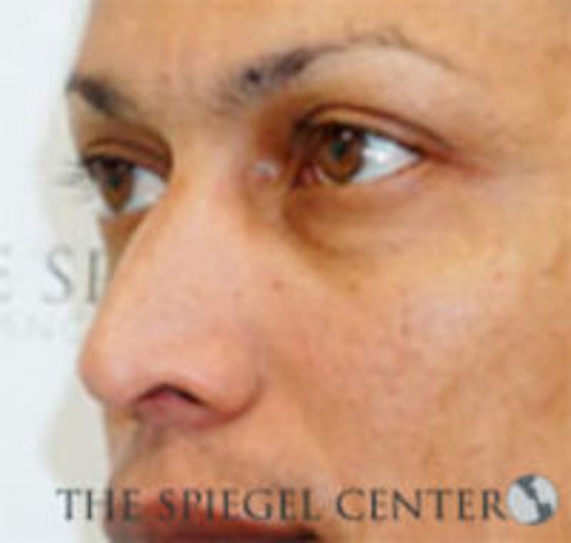 Rhinoplasty Before & After Gallery - Patient 213080 - Image 1