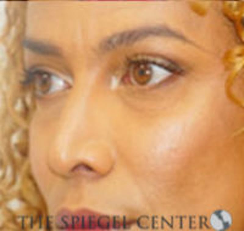 Rhinoplasty Before & After Gallery - Patient 213080 - Image 2