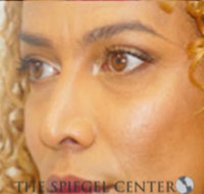 Rhinoplasty Before & After Gallery - Patient 213080 - Image 2