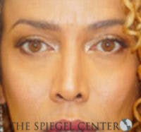 Rhinoplasty Before & After Gallery - Patient 213080 - Image 4