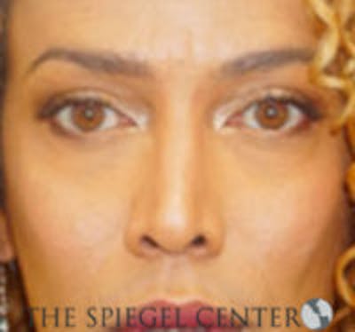 Rhinoplasty Before & After Gallery - Patient 213080 - Image 4