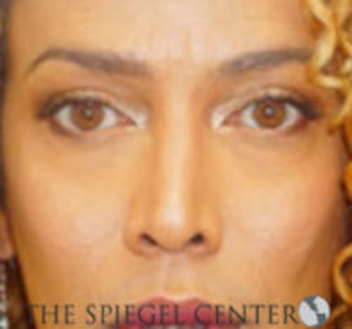 Rhinoplasty Before & After Gallery - Patient 213080 - Image 4