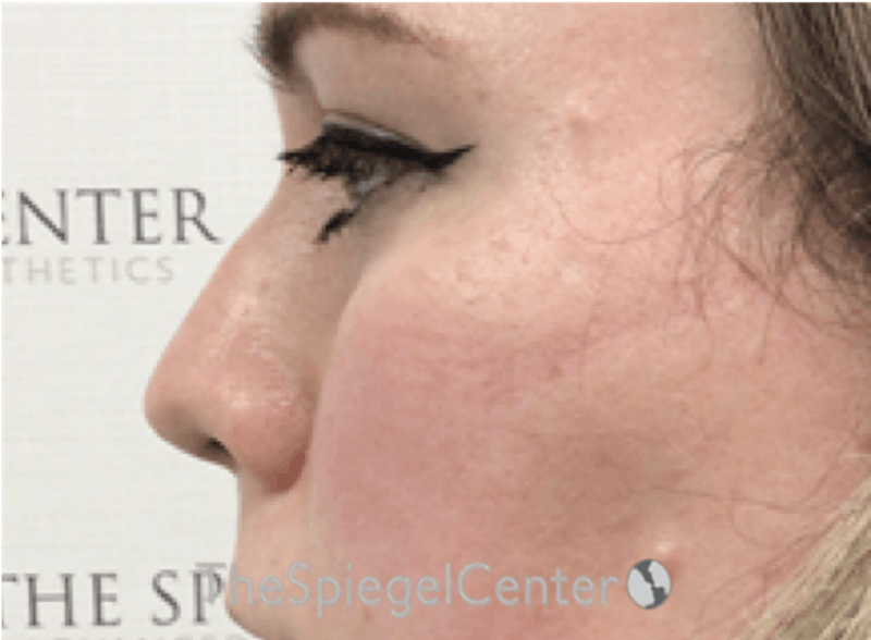 Rhinoplasty Before & After Gallery - Patient 899200 - Image 1