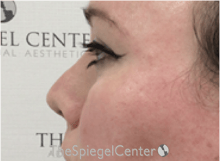 Rhinoplasty Before & After Gallery - Patient 899200 - Image 2