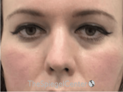 Rhinoplasty Before & After Gallery - Patient 899200 - Image 3