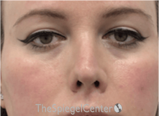 Rhinoplasty Before & After Gallery - Patient 899200 - Image 4
