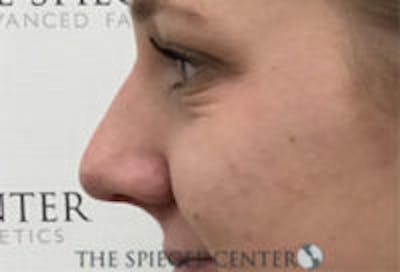 Rhinoplasty Before & After Gallery - Patient 402729 - Image 1