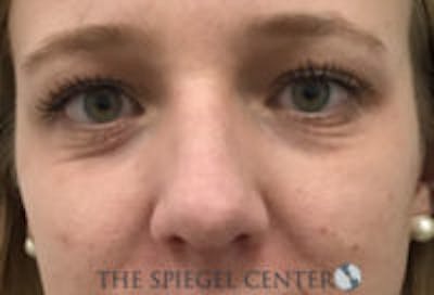 Rhinoplasty Before & After Gallery - Patient 402729 - Image 3