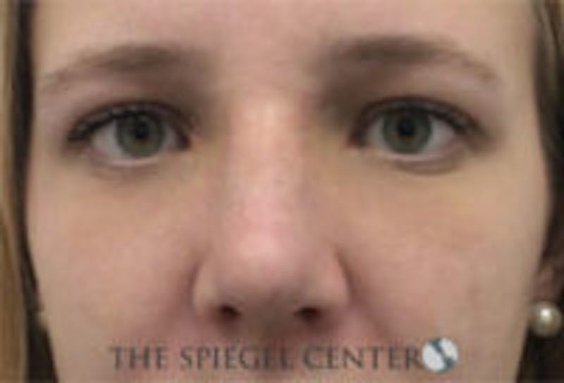 Rhinoplasty Before & After Gallery - Patient 402729 - Image 4