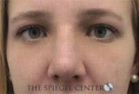 Rhinoplasty Before & After Gallery - Patient 402729 - Image 4