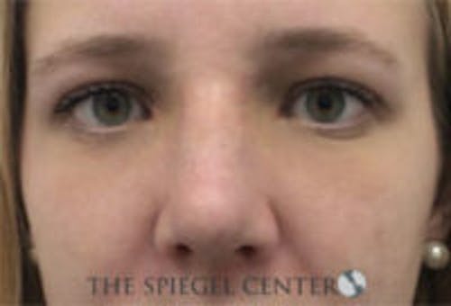 Rhinoplasty Before & After Gallery - Patient 402729 - Image 4