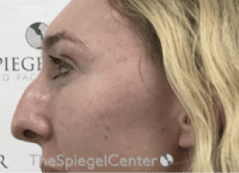Rhinoplasty Before & After Gallery - Patient 429228 - Image 1