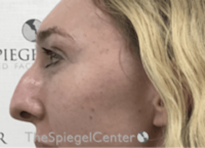Rhinoplasty Before & After Gallery - Patient 429228 - Image 1