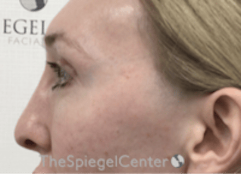 Rhinoplasty Before & After Gallery - Patient 429228 - Image 2