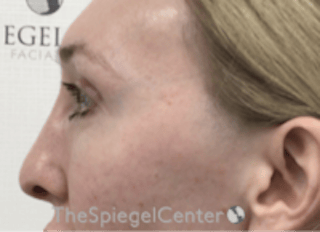 Rhinoplasty Before & After Gallery - Patient 429228 - Image 2