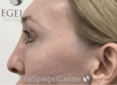 Rhinoplasty Before & After Gallery - Patient 429228 - Image 2