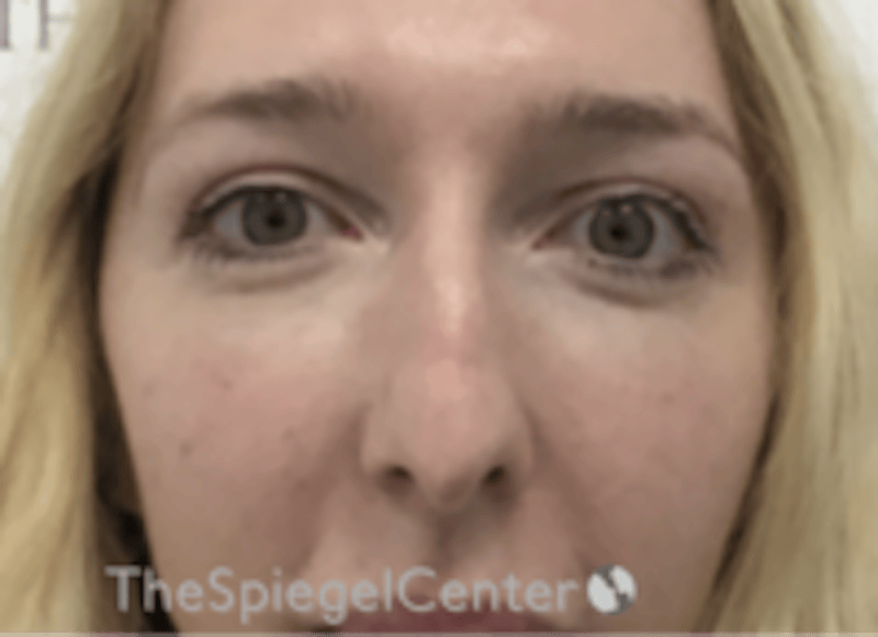 Rhinoplasty Before & After Gallery - Patient 429228 - Image 3