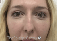 Rhinoplasty Before & After Gallery - Patient 429228 - Image 3