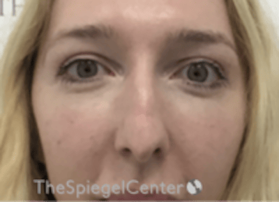 Rhinoplasty Before & After Gallery - Patient 429228 - Image 3