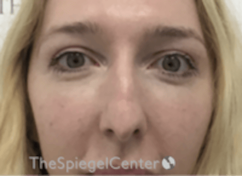 Rhinoplasty Before & After Gallery - Patient 429228 - Image 3