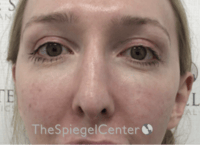 Rhinoplasty Before & After Gallery - Patient 429228 - Image 4