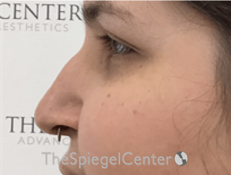 Rhinoplasty Before & After Gallery - Patient 257098 - Image 1