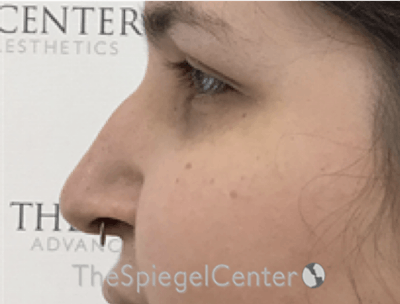 Rhinoplasty Before & After Gallery - Patient 257098 - Image 1