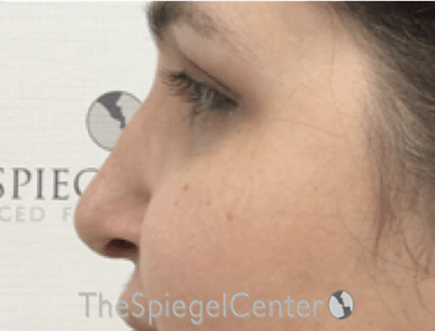 Rhinoplasty Before & After Gallery - Patient 257098 - Image 2