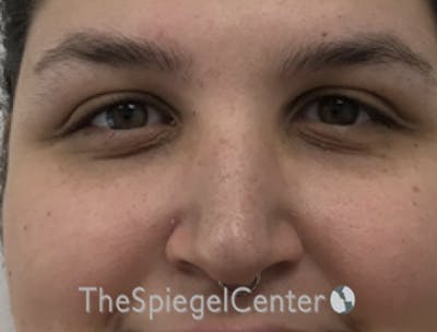 Rhinoplasty Before & After Gallery - Patient 257098 - Image 3