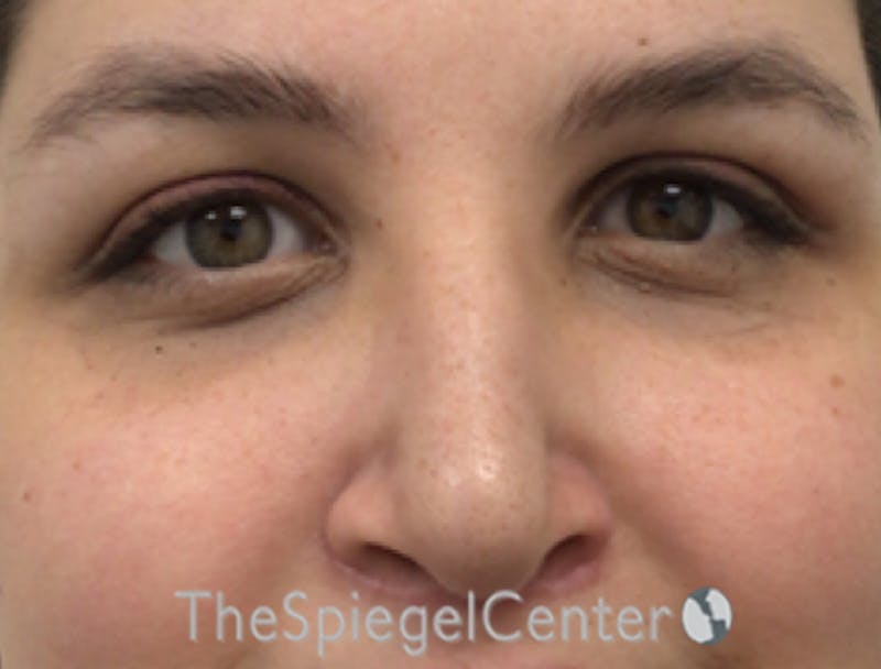 Rhinoplasty Before & After Gallery - Patient 257098 - Image 4