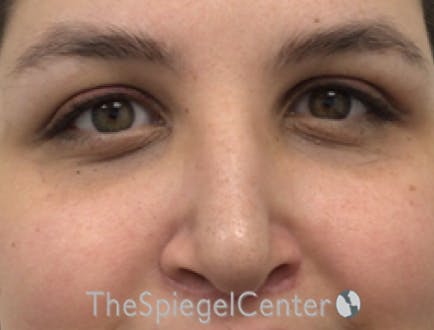 Rhinoplasty Before & After Gallery - Patient 257098 - Image 4