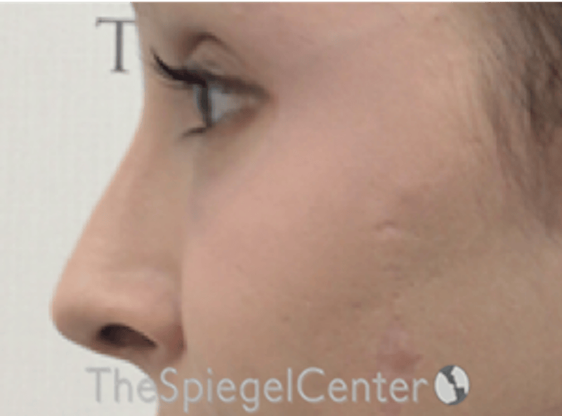 Rhinoplasty Before & After Gallery - Patient 286486 - Image 1