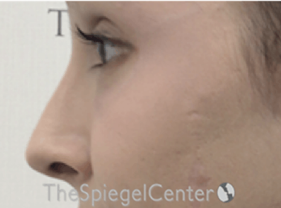Rhinoplasty Before & After Gallery - Patient 286486 - Image 1