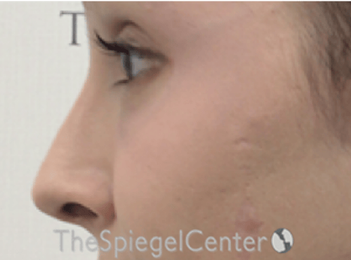 Rhinoplasty Before & After Gallery - Patient 286486 - Image 1