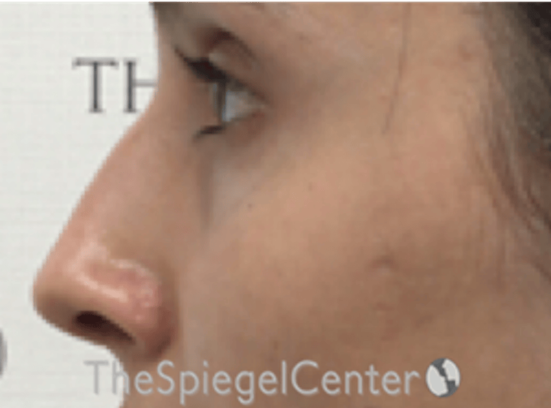 Rhinoplasty Before & After Gallery - Patient 286486 - Image 2