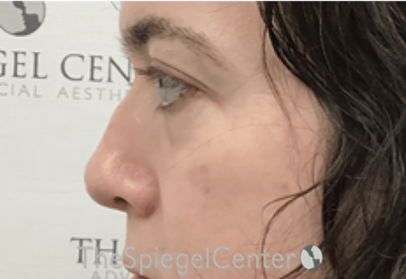 Rhinoplasty Before & After Gallery - Patient 114442 - Image 1
