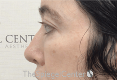Rhinoplasty Before & After Gallery - Patient 114442 - Image 2