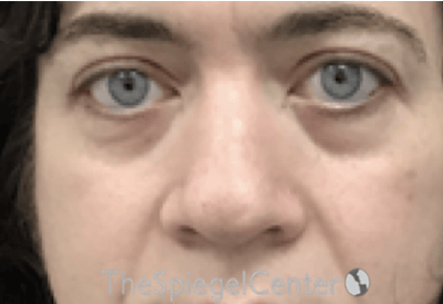 Rhinoplasty Before & After Gallery - Patient 114442 - Image 3