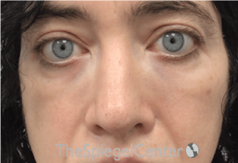Rhinoplasty Before & After Gallery - Patient 114442 - Image 4