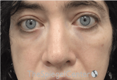 Rhinoplasty Before & After Gallery - Patient 114442 - Image 4