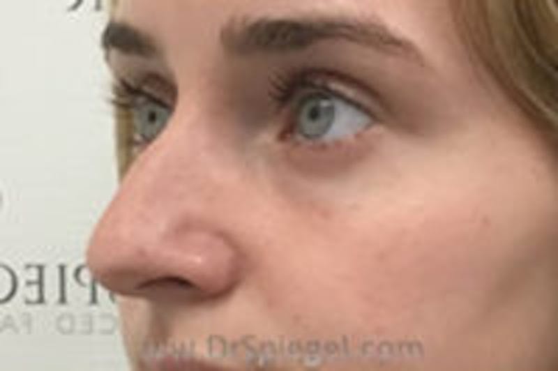 Rhinoplasty Before & After Gallery - Patient 708675 - Image 1