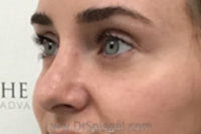 Rhinoplasty Before & After Gallery - Patient 708675 - Image 2