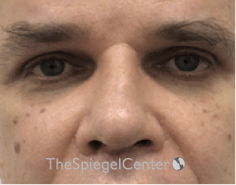 Rhinoplasty Before & After Gallery - Patient 143051 - Image 4